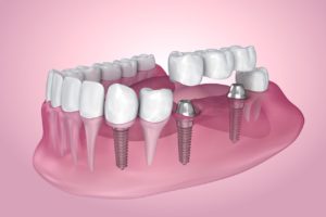 types of dental implants Los Altos California