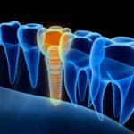dental implant treatment recovery