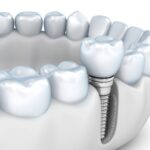 Jawbone Health After Tooth Loss