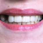 What Causes Tooth Loss