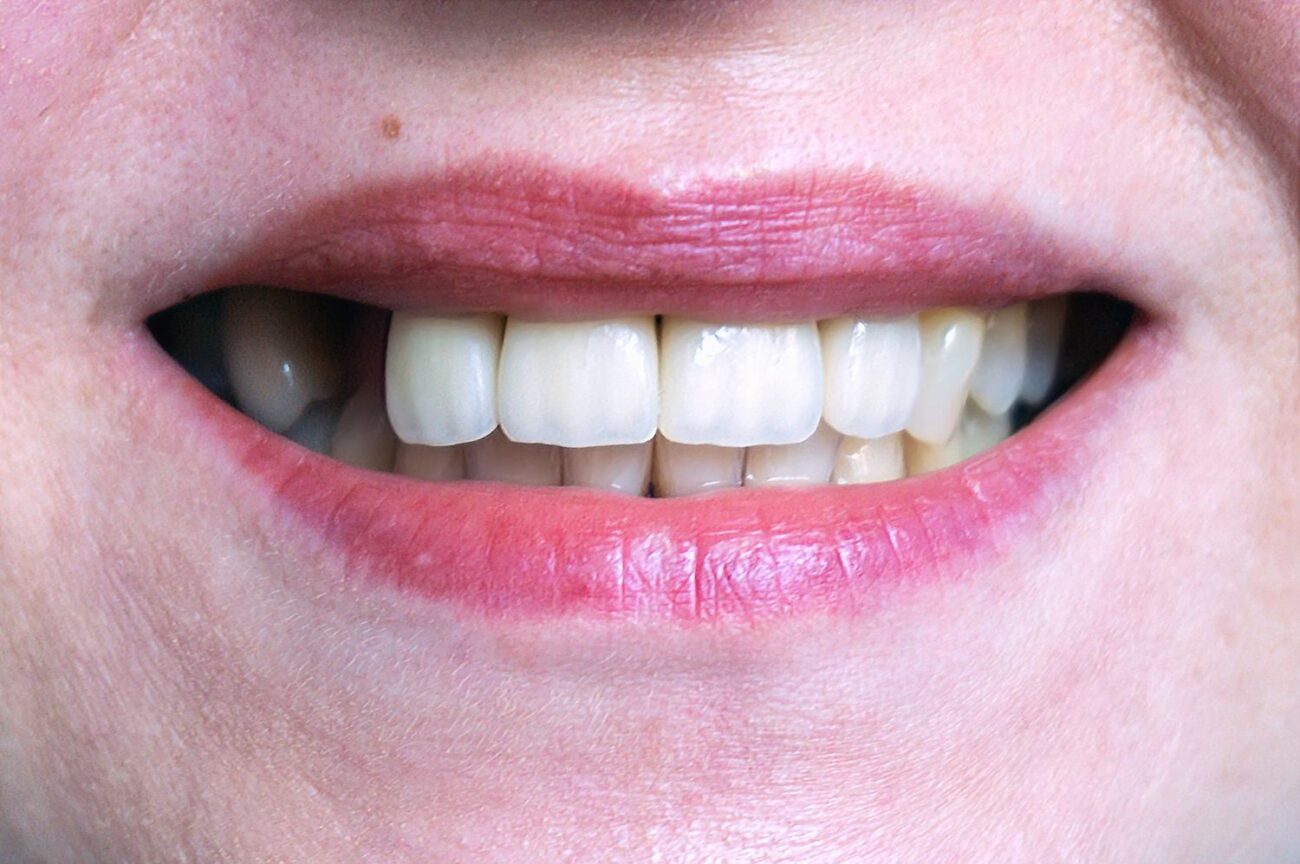 Tooth extractions in Los Altos CA