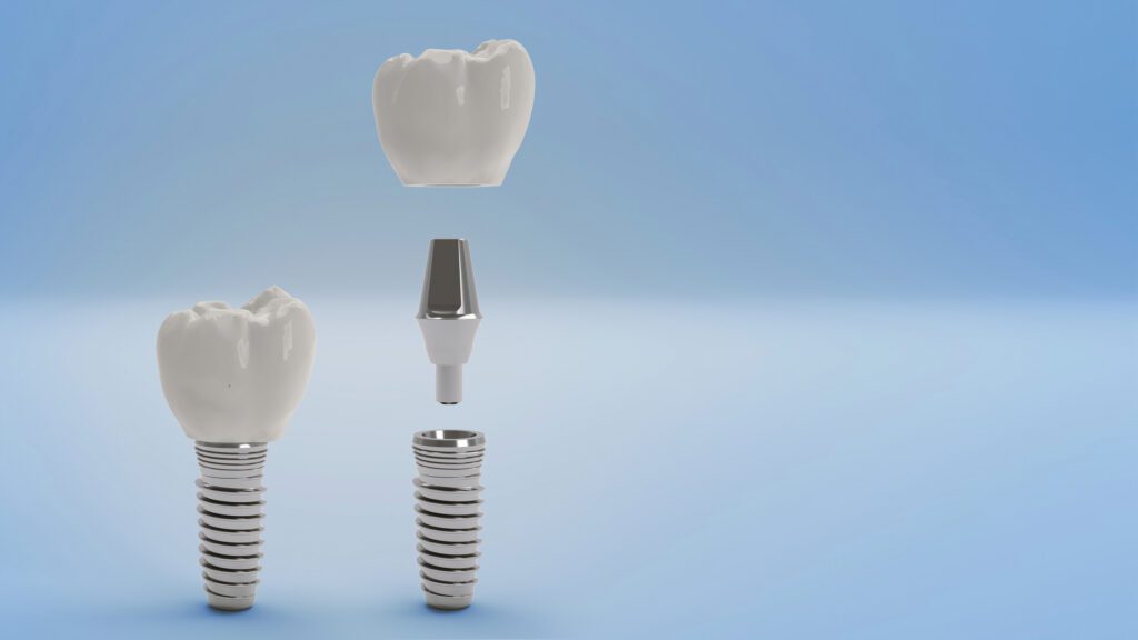 Dental Implants Palo Alto CA